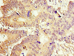 Immunohistochemistry of paraffin-embedded human colon cancer using CSB-PA001169ESR2HU at dilution of 1:100