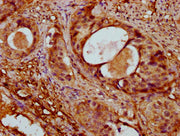 IHC image of CSB-PA001205NJ01HU diluted at 1:400 and staining in paraffin-embedded human cervical cancer performed on a Leica BondTM system. After dewaxing and hydration, antigen retrieval was mediated by high pressure in a citrate buffer (pH 6.0)...
