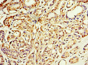 Immunohistochemistry of paraffin-embedded human breast cancer using CSB-PA001355ESR1HU at dilution of 1:100