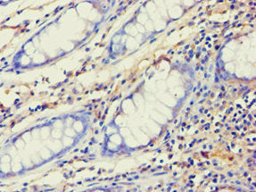 Immunohistochemistry of paraffin-embedded human colon cancer using CSB-PA001405ESR2HU at dilution of 1:100