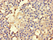 Immunohistochemistry of paraffin-embedded human breast cancer using CSB-PA001474LA01HU at dilution of 1:100