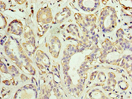 Immunohistochemistry of paraffin-embedded human breast cancer using CSB-PA001519ESR2HU at dilution of 1:100