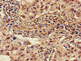 Immunohistochemistry of paraffin-embedded human lung cancer using CSB-PA001559LA01HU at dilution of 1:100
