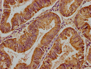 IHC image of CSB-PA001621LA01HU diluted at 1:400 and staining in paraffin-embedded human endometrial cancer performed on a Leica BondTM system. After dewaxing and hydration, antigen retrieval was mediated by high pressure in a citrate buffer (pH 6...