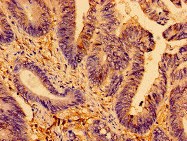 Immunohistochemistry of paraffin-embedded human colon cancer using CSB-PA001681LA01HU at dilution of 1:100