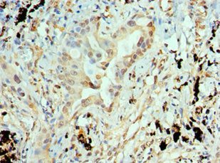 Immunohistochemistry of paraffin-embedded human lung cancer using CSB-PA001832ESR1HU at dilution of 1:100