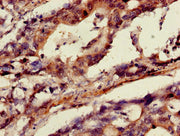 Immunohistochemistry of paraffin-embedded human gastric cancer using CSB-PA001837LA01HU at dilution of 1:100