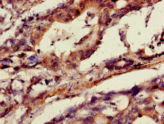 Immunohistochemistry of paraffin-embedded human gastric cancer using CSB-PA001837LA01HU at dilution of 1:100