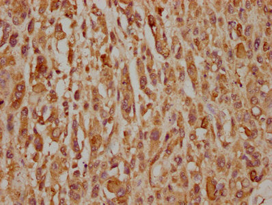 IHC image of CSB-PA001898LA01HU diluted at 1:320 and staining in paraffin-embedded human melanoma cancer performed on a Leica BondTM system. After dewaxing and hydration, antigen retrieval was mediated by high pressure in a citrate buffer (pH 6.0)...
