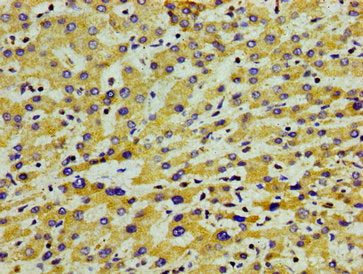 Immunohistochemistry of paraffin-embedded human liver cancer using CSB-PA001917LA01HU at dilution of 1:100
