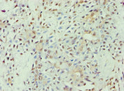 Immunohistochemistry of paraffin-embedded human breast cancer using CSB-PA001940ESR1HU at dilution of 1:100