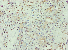 Immunohistochemistry of paraffin-embedded human breast cancer using CSB-PA001940ESR1HU at dilution of 1:100