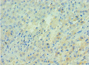 Immunohistochemistry of paraffin-embedded human liver cancer using CSB-PA001954DSR2HU at dilution of 1:100