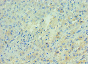 Immunohistochemistry of paraffin-embedded human liver cancer using CSB-PA001954DSR2HU at dilution of 1:100