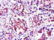 Immunohistochemistry of paraffin-embedded human gastric cancer using CSB-PA001955LA01HU at dilution of 1:100