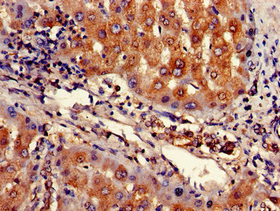Immunohistochemistry of paraffin-embedded human liver cancer using CSB-PA002026LA01HU at dilution of 1:100