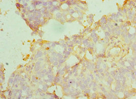 Immunohistochemistry of paraffin-embedded human endometrial cancer using CSB-PA002118ESR1HU at dilution of 1:100