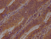 IHC image of CSB-PA002155LA01HU diluted at 1:400 and staining in paraffin-embedded human colon cancer performed on a Leica BondTM system. After dewaxing and hydration, antigen retrieval was mediated by high pressure in a citrate buffer (pH 6.0). S...