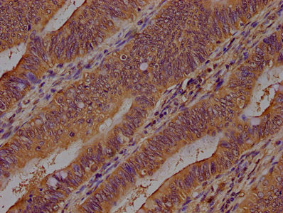 IHC image of CSB-PA002155LA01HU diluted at 1:400 and staining in paraffin-embedded human colon cancer performed on a Leica BondTM system. After dewaxing and hydration, antigen retrieval was mediated by high pressure in a citrate buffer (pH 6.0). S...