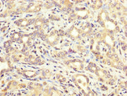 IHC image of CSB-PA002268LA01HU diluted at 1:200 and staining in paraffin-embedded human liver cancer performed on a Leica BondTM system. After dewaxing and hydration, antigen retrieval was mediated by high pressure in a citrate buffer (pH 6.0). S...