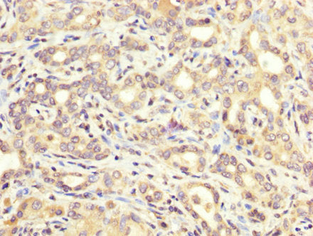 IHC image of CSB-PA002268LA01HU diluted at 1:200 and staining in paraffin-embedded human liver cancer performed on a Leica BondTM system. After dewaxing and hydration, antigen retrieval was mediated by high pressure in a citrate buffer (pH 6.0). S...
