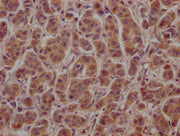 IHC image of CSB-PA002272LA01HU diluted at 1:100 and staining in paraffin-embedded human breast cancer performed on a Leica BondTM system. After dewaxing and hydration, antigen retrieval was mediated by high pressure in a citrate buffer (pH 6.0)....