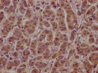 IHC image of CSB-PA002272LA01HU diluted at 1:100 and staining in paraffin-embedded human breast cancer performed on a Leica BondTM system. After dewaxing and hydration, antigen retrieval was mediated by high pressure in a citrate buffer (pH 6.0)....