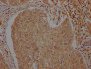 IHC image of CSB-PA002277LA01HU diluted at 1:100 and staining in paraffin-embedded human cervical cancer performed on a Leica BondTM system. After dewaxing and hydration, antigen retrieval was mediated by high pressure in a citrate buffer (pH 6.0)...