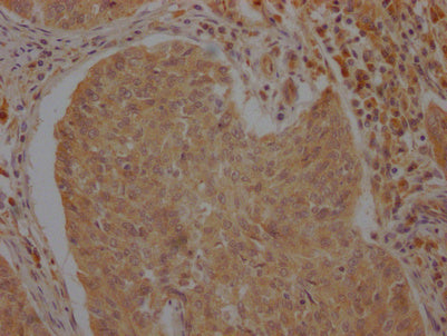 IHC image of CSB-PA002277LA01HU diluted at 1:100 and staining in paraffin-embedded human cervical cancer performed on a Leica BondTM system. After dewaxing and hydration, antigen retrieval was mediated by high pressure in a citrate buffer (pH 6.0)...