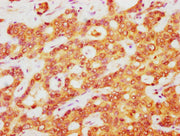 IHC image of CSB-PA002309LA01HU diluted at 1:400 and staining in paraffin-embedded human liver cancer performed on a Leica BondTM system. After dewaxing and hydration, antigen retrieval was mediated by high pressure in a citrate buffer (pH 6.0). S...