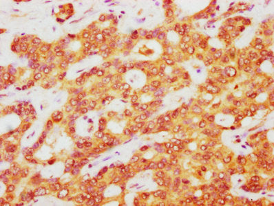 IHC image of CSB-PA002309LA01HU diluted at 1:400 and staining in paraffin-embedded human liver cancer performed on a Leica BondTM system. After dewaxing and hydration, antigen retrieval was mediated by high pressure in a citrate buffer (pH 6.0). S...