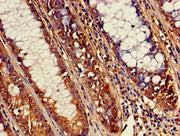 Immunohistochemistry of paraffin-embedded human colon cancer using CSB-PA002328LA01HU at dilution of 1:100