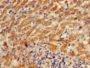 Immunohistochemistry of paraffin-embedded human liver cancer using CSB-PA002355HA01HU at dilution of 1:100