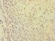 Immunohistochemistry of paraffin-embedded human breast cancer using CSB-PA002369ESR2HU at dilution of 1:100