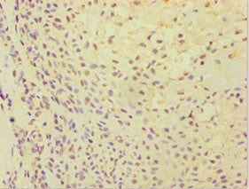Immunohistochemistry of paraffin-embedded human breast cancer using CSB-PA002369ESR2HU at dilution of 1:100