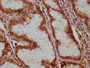 IHC image of CSB-PA002399LA01HU diluted at 1:100 and staining in paraffin-embedded human gastric cancer performed on a Leica BondTM system. After dewaxing and hydration, antigen retrieval was mediated by high pressure in a citrate buffer (pH 6.0)....