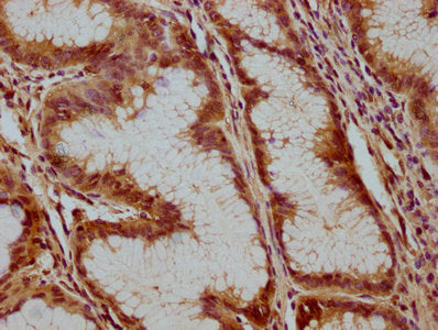 IHC image of CSB-PA002399LA01HU diluted at 1:100 and staining in paraffin-embedded human gastric cancer performed on a Leica BondTM system. After dewaxing and hydration, antigen retrieval was mediated by high pressure in a citrate buffer (pH 6.0)....