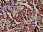 IHC image of CSB-PA002424LA01HU diluted at 1:400 and staining in paraffin-embedded human lung cancer performed on a Leica BondTM system. After dewaxing and hydration, antigen retrieval was mediated by high pressure in a citrate buffer (pH 6.0). Se...