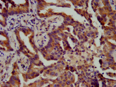IHC image of CSB-PA002424LA01HU diluted at 1:400 and staining in paraffin-embedded human lung cancer performed on a Leica BondTM system. After dewaxing and hydration, antigen retrieval was mediated by high pressure in a citrate buffer (pH 6.0). Se...