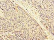 Immunohistochemistry of paraffin-embedded human ovarian cancer using CSB-PA002435ESR1HU at dilution of 1:100