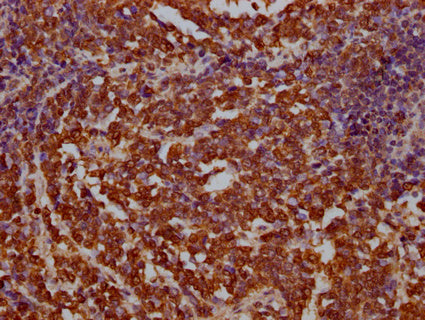 IHC image of CSB-PA002531LA01HU diluted at 1:100 and staining in paraffin-embedded human lung cancer performed on a Leica BondTM system. After dewaxing and hydration, antigen retrieval was mediated by high pressure in a citrate buffer (pH 6.0). Se...