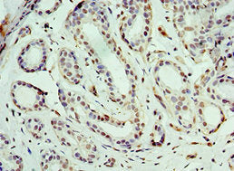 Immunohistochemistry of paraffin-embedded human breast cancer using CSB-PA002597ESR2HU at dilution of 1:100