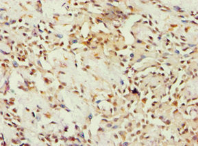 Immunohistochemistry of paraffin-embedded human breast cancer using CSB-PA002607ESR1HU at dilution of 1:100