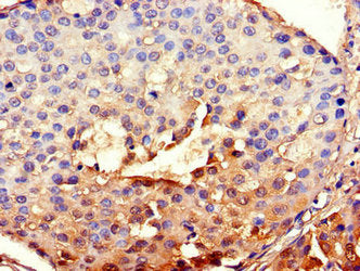 Immunohistochemistry of paraffin-embedded human breast cancer using CSB-PA002691LA01HU at dilution of 1:100