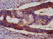 IHC image of CSB-PA002698HA01HU diluted at 1:1200 and staining in paraffin-embedded human colon cancer performed on a Leica BondTM system. After dewaxing and hydration, antigen retrieval was mediated by high pressure in a citrate buffer (pH 6.0)....