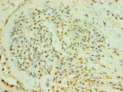 Immunohistochemistry of paraffin-embedded human breast cancer using CSB-PA002714ESR1HU at dilution of 1:100