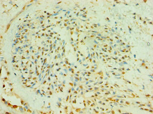 Immunohistochemistry of paraffin-embedded human breast cancer using CSB-PA002714ESR1HU at dilution of 1:100