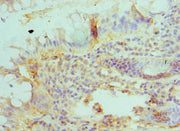 Immunohistochemistry of paraffin-embedded human colon cancer using CSB-PA002716ESR2HU at dilution of 1:100