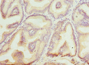Immunohistochemistry of paraffin-embedded human prostate cancer using CSB-PA002721ESR1HU at dilution of 1:100