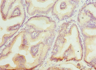 Immunohistochemistry of paraffin-embedded human prostate cancer using CSB-PA002721ESR1HU at dilution of 1:100